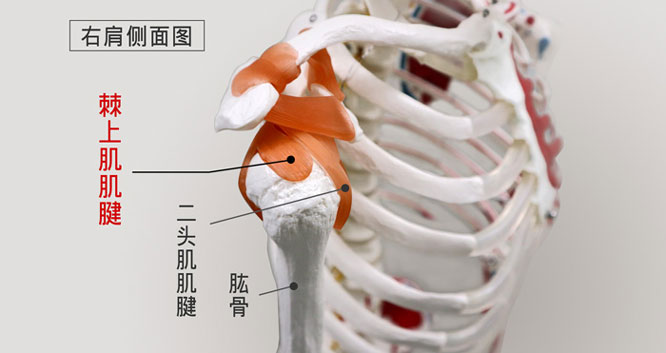 棘上肌肌腱最常发生钙化性肌腱炎